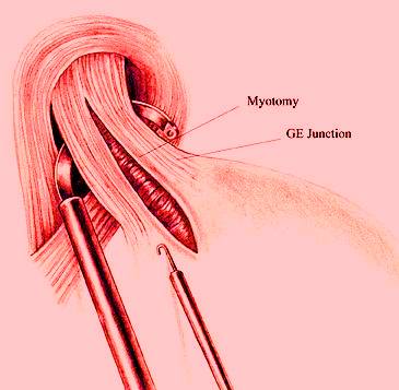 heller myotomy laparoscopic achalasia frequently asked questions laparoscopyhospital